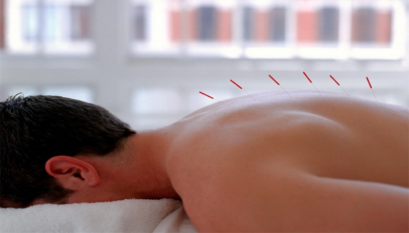 Peran Akupunktur pada Pengobatan Stroke