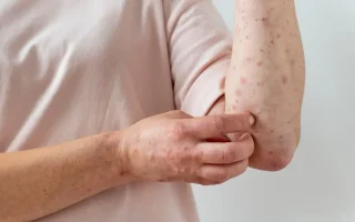 tanda penyakit campak