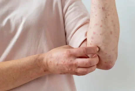 tanda penyakit campak